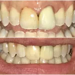 A representation of before and after a dental procedure