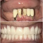 An image showing before and after dental implants to replace missing teeth