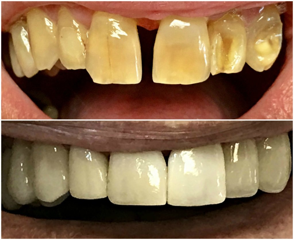 Before and After a dental procedure for same day all porcelain crowns and veneers.