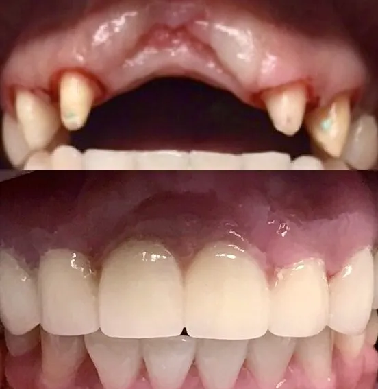 Before and After photos of Bone grafting material for upper arch, and full arch restoration.