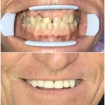 Before and after same day anterior veneers