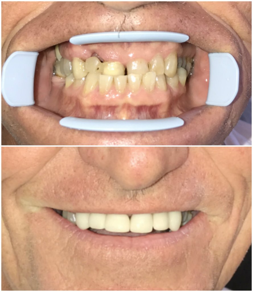 Before and after same day anterior veneers