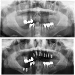 Before and after multiple implant placement