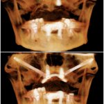 Before and after Zygomatic implants