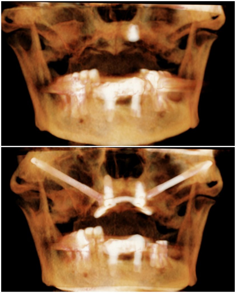 Before and after Zygomatic implants