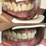 Before and After photos for a Same-Day Cerec Crown Restoration