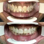 Before and After photos for a Cerec Crown Restoration that was completed Same-Day