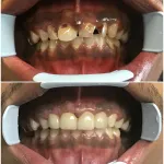 Before and After photos of treatment by Dr. Harry Panahi at {PRACTICE_NAME}